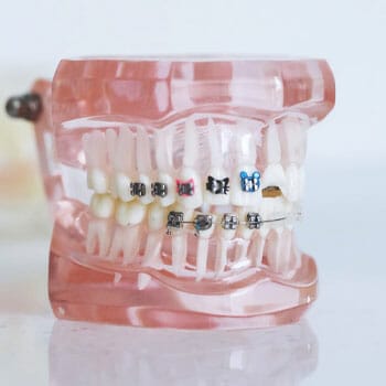 teeth model with braces