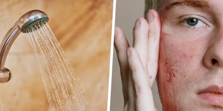 your guide to acne and cold showers