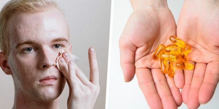 Your guide to fish oil and acne