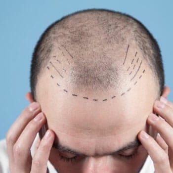 man with lines drawn on his receding hairline