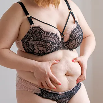 big woman showing her body fats