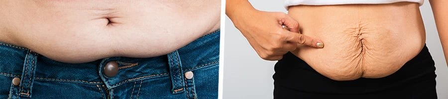Loose skin of different person